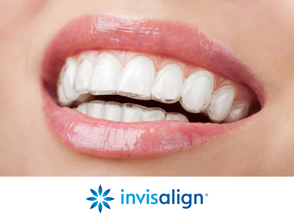 apparecchi invisibili cava manara pavia