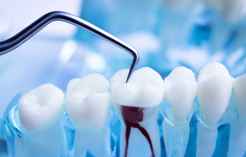 devitalizzazione dente