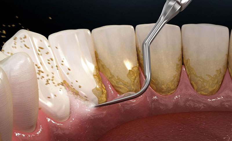 pulizia dei denti pavia cava manara